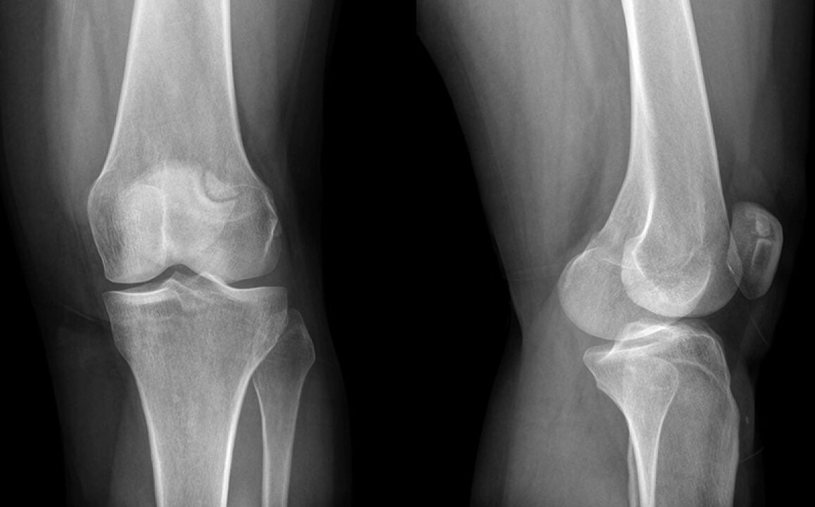 L'arthrose du genou sur la rayon X avant l'utilisation de Hondroine