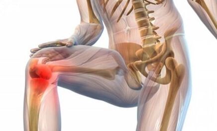 Arthrose de l'articulation du genou