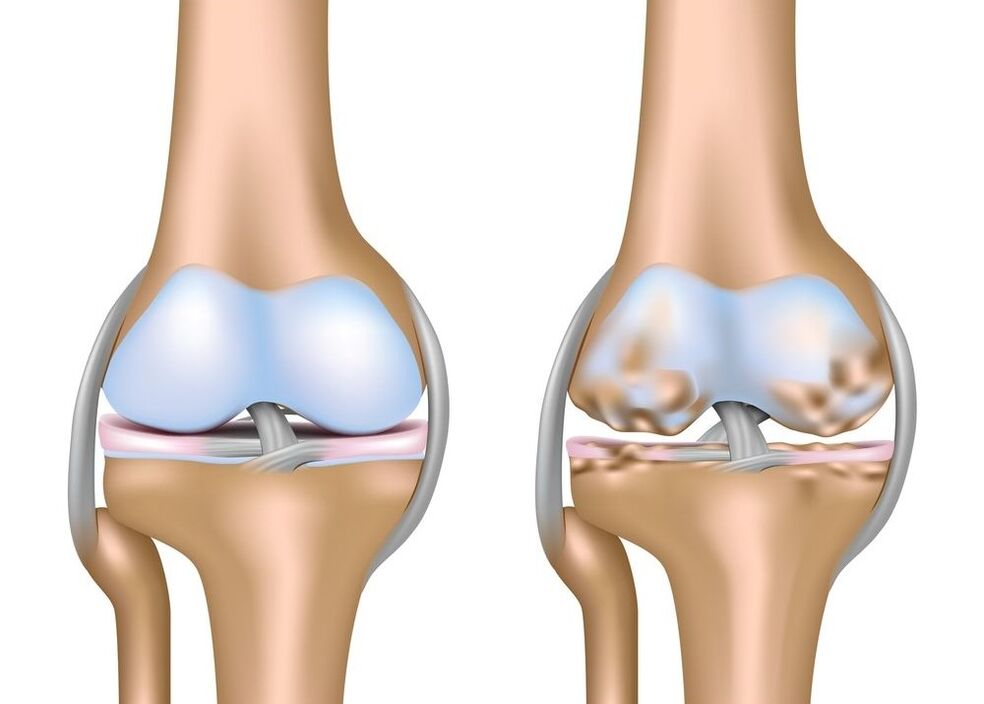 Arthrose de l'articulation du genou