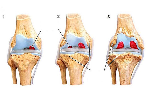 Le degré de développement de l'arthrose