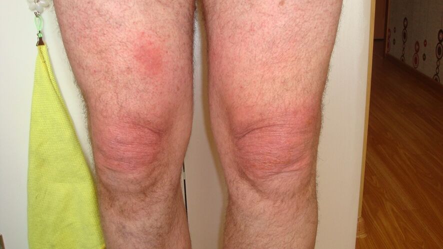 arthrose des articulations du genou